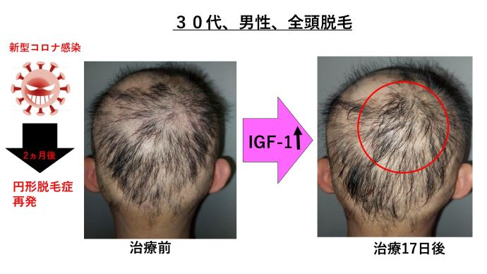 円形脱毛症　病院